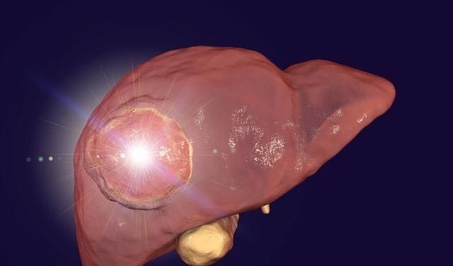 小便短赤|48岁男子误以为肩周炎,却查出肝癌肩膀若突现这1症状,别拖延