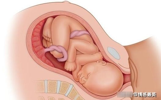 脐带绕颈|孕妇有这个感觉，并不是好事，可能是胎儿“脐带绕颈”