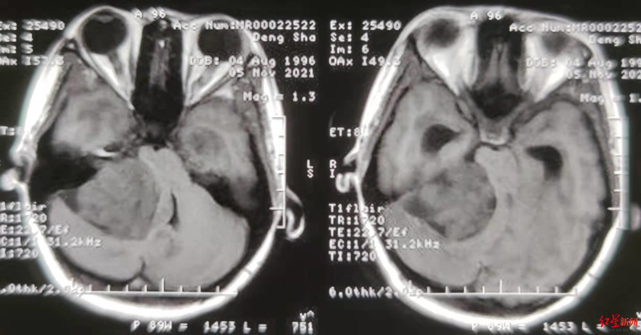 李春玲|46天生死考验：女子孕期确诊巨大听神经瘤，历经三次手术，安全生下女婴