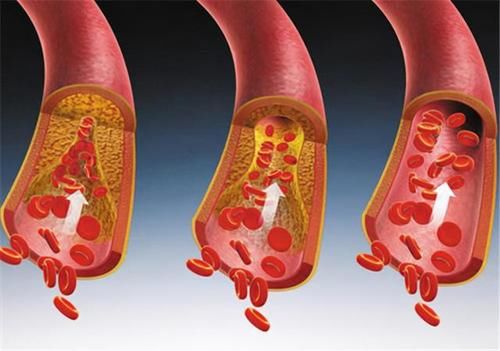 服用|新型降压药,沙库巴曲缬沙坦,高血压患者的希望