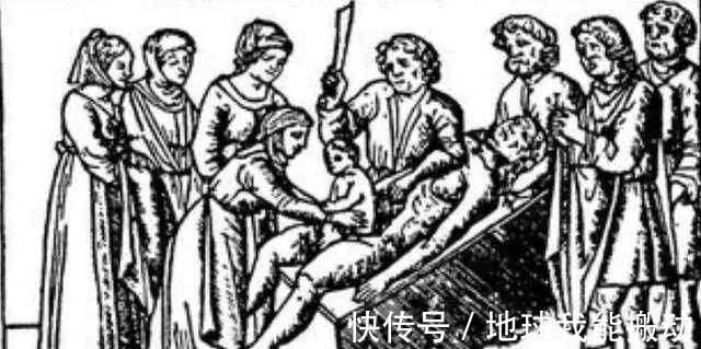 剖腹产|西方发明的一种手术,早期死亡率高达85%,却给中国妇女带来福音!