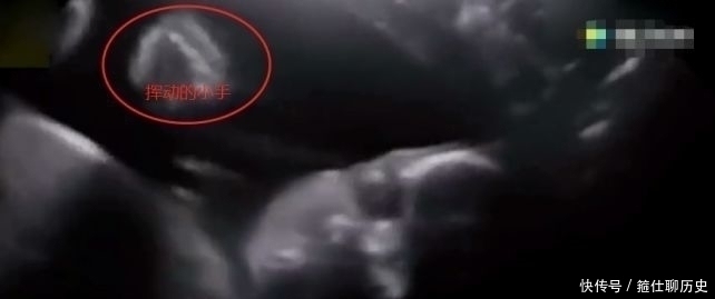 伊安娜|孕妇做B超被吓坏,孩子突然睁眼怪笑!医生却说……