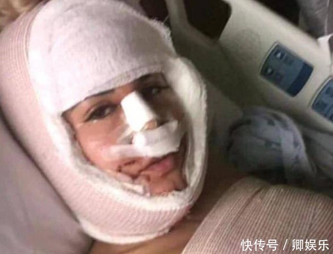 女子花重金整容,一年经历13次整容手术,整容前后判若两人!