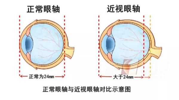 高度近视|深圳一女生摸黑玩手机瞳孔变白，罪魁祸首竟是...