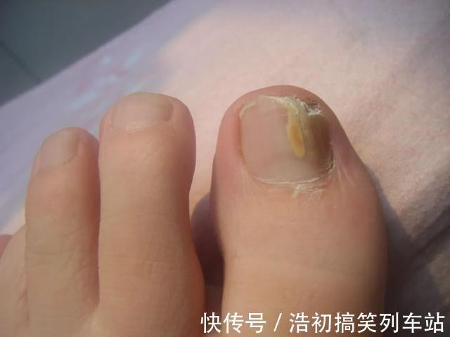 血脂值|血脂高不高,双腿先知道,当腿部出现这4种症状时,需要引起重视