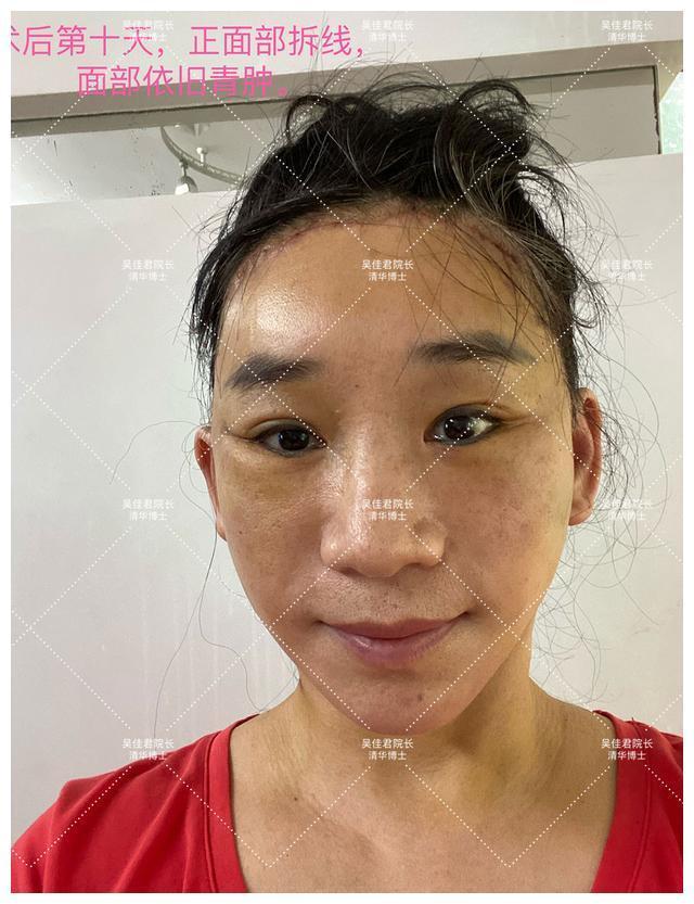 面部 51岁小拉皮术后1个月,我想跟大家说点真心话