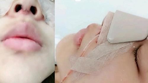 自体软骨垫鼻尖为什么会越来越低？