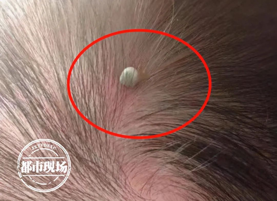 南昌|南昌一宝宝出生才4天，就被小虫咬了