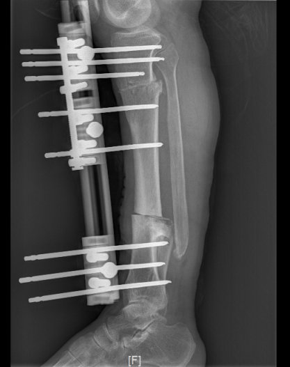 犀利！14年的长短腿一朝治愈|【三水人医】专科技术 | 陈旧性骨折
