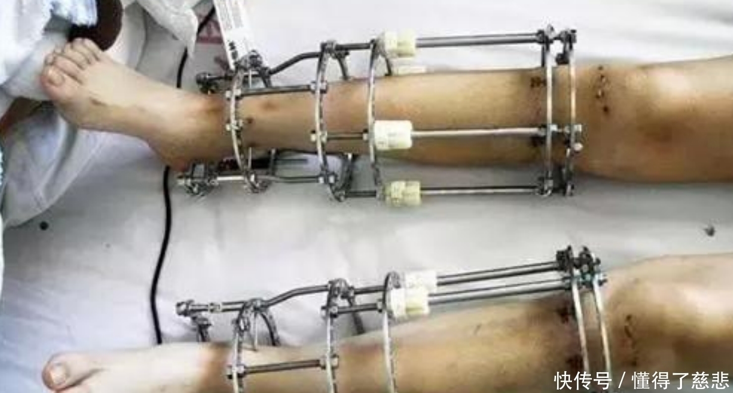 长高|6年前花16万,断骨增高7.2厘米的男生李亚诺,现在代价来了