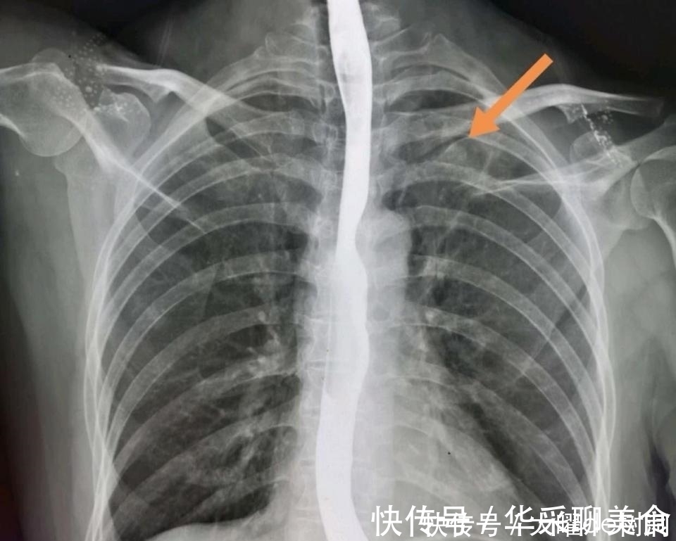 体检|年年体检,为什么还得了晚期肺癌?体检有啥用!