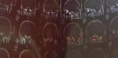 委中|脑出血瘫痪生活不能自理，中医只用1招就让他走起来了