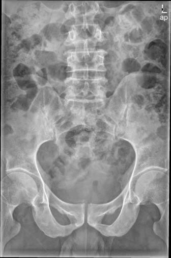 椎体|脊柱常见肿瘤及肿瘤样病变的几种影像学表现,你都见过吗?