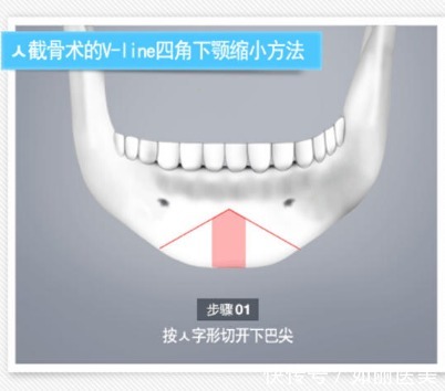 操作方法 下巴截骨术危险吗?手术注意事项须知及术后怎么护理?看完全明白了!