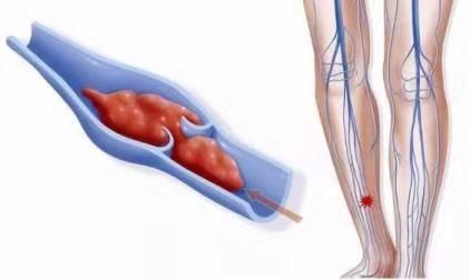  疾病|肢肿胀 小心这种疾病来“敲门”