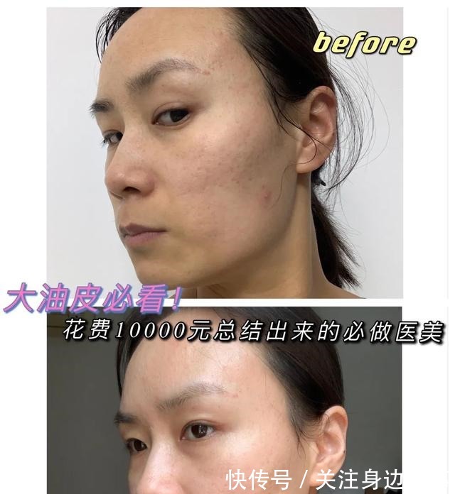 大油皮 大油皮必看!花费10000元总结出来的医美项目推荐!