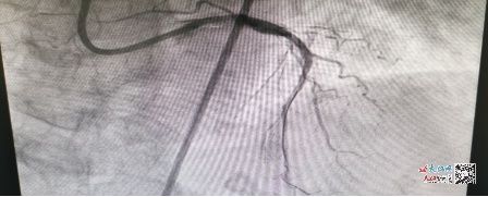 手术治疗|南昌大学二附院运用省首台新型激光治疗仪成功治疗高危复杂冠心病