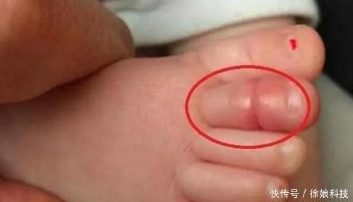 脚趾|4岁孩子脚趾肿的厉害,妈妈不放心带去医院,医生幸好来得早