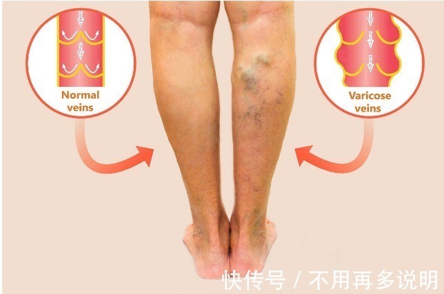 腿部|血脂升高,腿脚先知!腿脚出现4种“怪象”,提示你该降血脂了