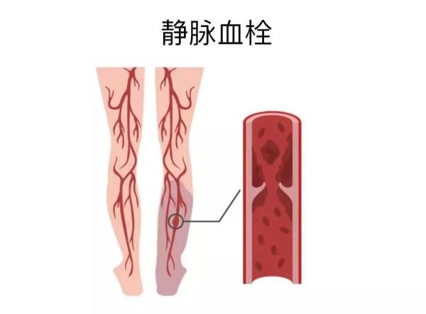 肺栓塞|它是心梗、脑梗的元凶，更容易找上这些人