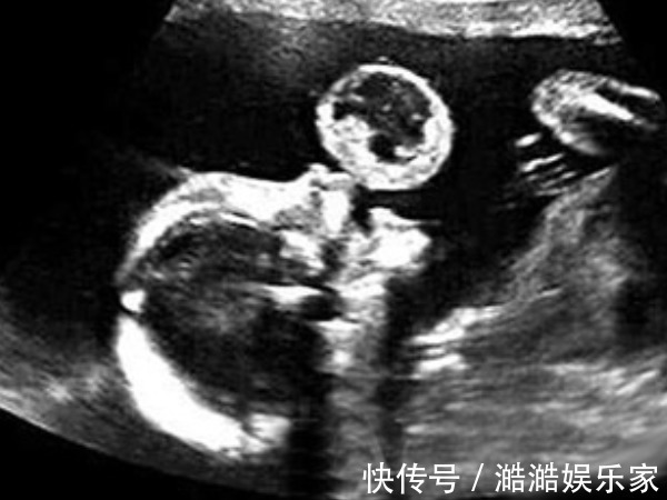 荷尔蒙|怀孕后,为何有人一直吐,有人却从不吐医生和腹中胎儿有关