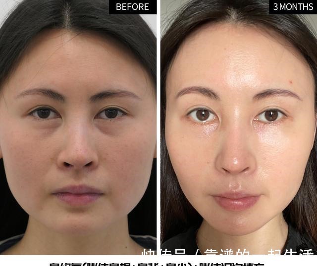 黑眼圈 求美者很想撤回的照片,真实记录泪沟、鼻修复术后3个月效果变化!