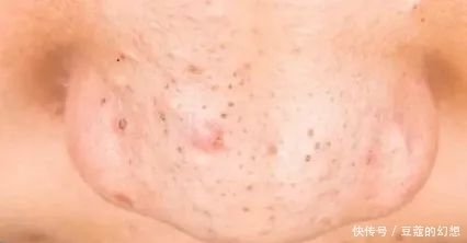 黑头|鼻头上 “黑头粉刺” 的清除方法及误区……及时纠正!