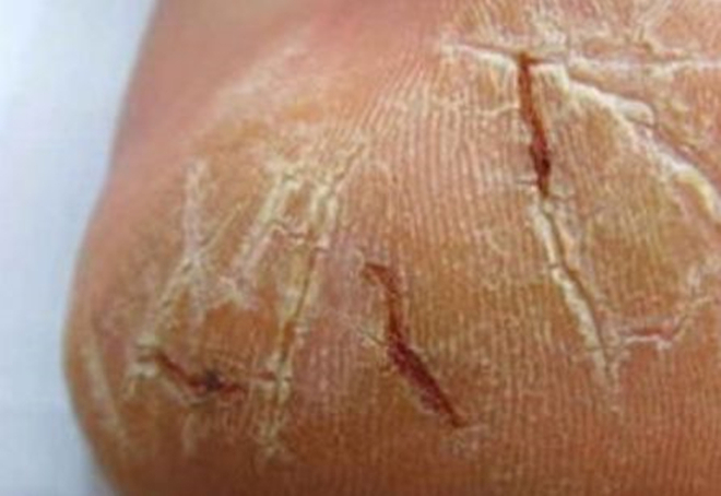 裂田|脚后跟的“裂田”,是因为缺水吗并非那么简单,劝你心里有个数