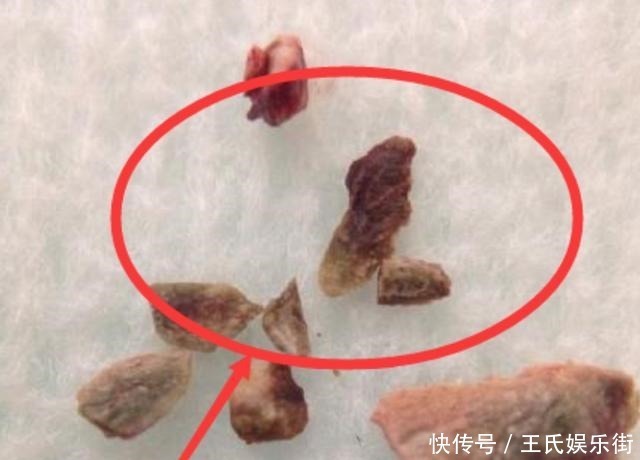 水漱|孩子被嘲笑“嘴太臭”，被同学孤立，医生取出小颗粒，宝妈都嫌臭