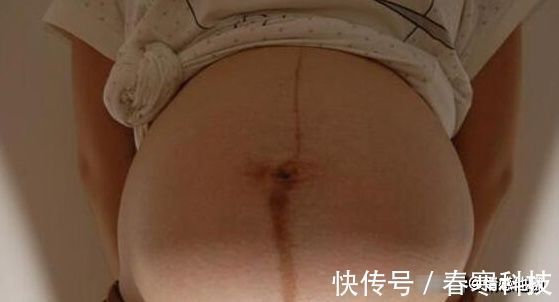 男孩女孩|孕妇肚脐中间有条黑线,为啥有的笔直一条,有的却偏左或偏右?