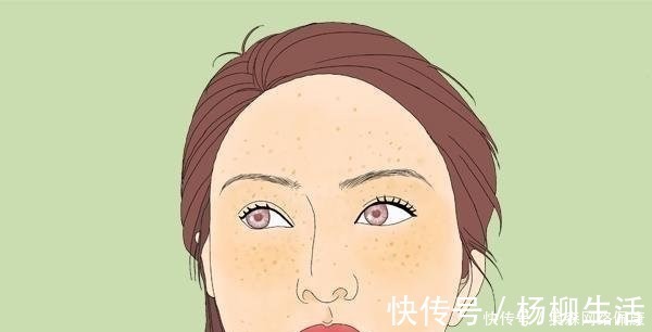 蜘蛛痣|肝病先上脸,脸部出现什么变化,暗示肝脏病得不轻了?别大意