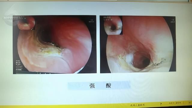 实验|全国各地都有孩子误食这个东西！记者用鸡肉做实验，结果触目惊心