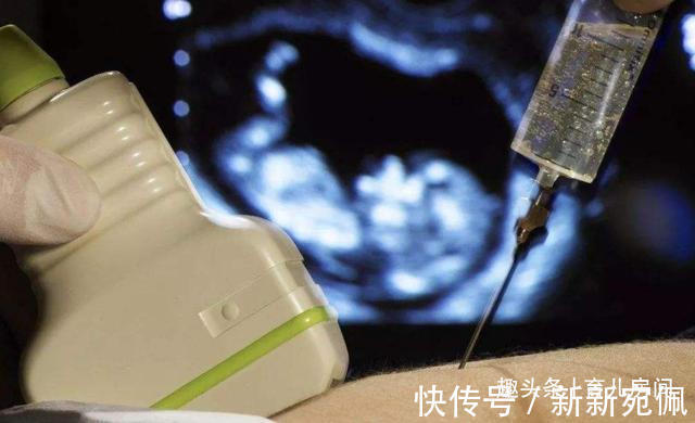 孕妈|如今“唐氏宝宝”多了起来,诱因多半在于父母,这3种孕妈要小心