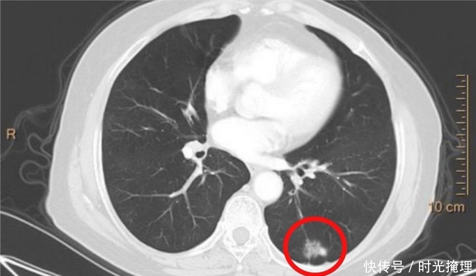 化疗|化疗会造成癌症扩散吗?