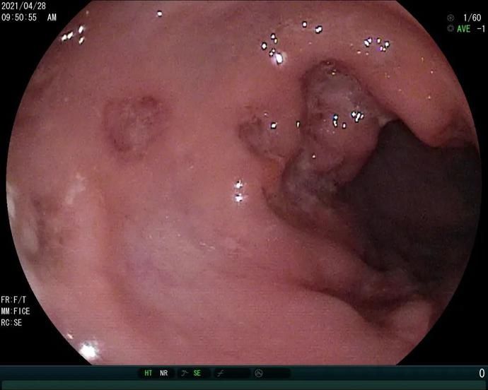 腹泻|从无锡治到上海，这个宝宝的“急性肠炎”不一般