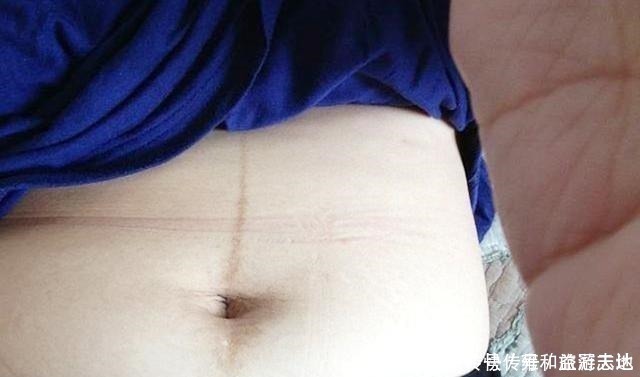 肚皮|在怀孕后，女性皮肤上的变化较为明显，这五点看看你有没有中招