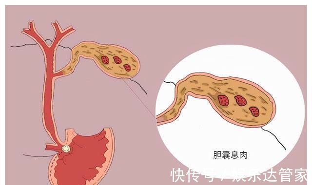 胆囊息肉|胆囊息肉你知多少?这时候了解,还不算晚