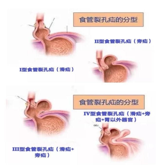 宇宇|广西1岁幼儿频繁呕吐,医院一检查,胃不见了！