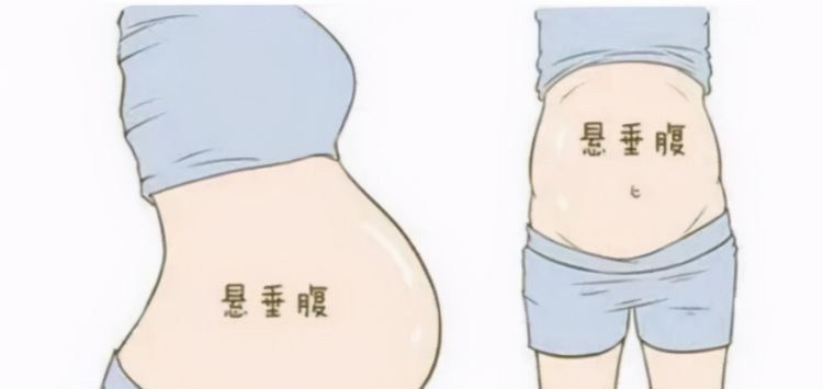 悬垂肚|孕妇“悬垂肚”走红,头回见到这种胎型,护士坦言:对宝妈不好