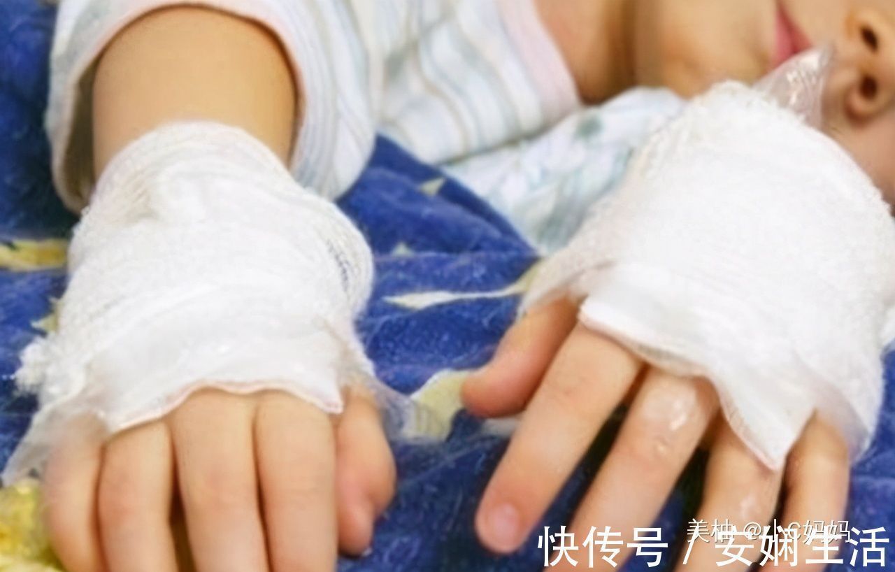 宝妈|3岁男孩被开水烫伤,宝妈的急救方法,医生称赞连连