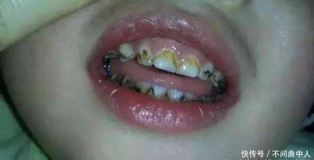 孩子们|家里这3样东西，比糖还容易让孩子长“黑牙”，家长别让孩子碰