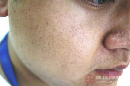 痘痘反复出现的原因是什么