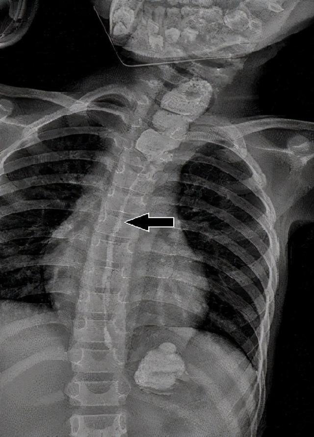 女孩|喝了一小口“水”,9岁女孩食管萎缩,影响进食近8个月