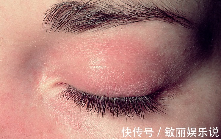 忠告|为什么肺癌越来越多?忠告:少惹三种“气”,头部3个表现要就医