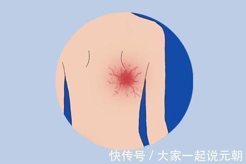 规则性|皮肤下面长出大包,是癌症信号?医生哭笑不得:满足3点才有可能