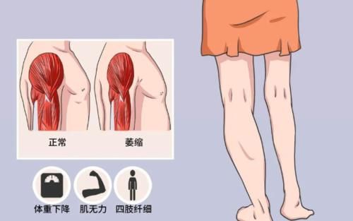 关节|「肌肉萎缩」一直练力量，膝盖还是痛？