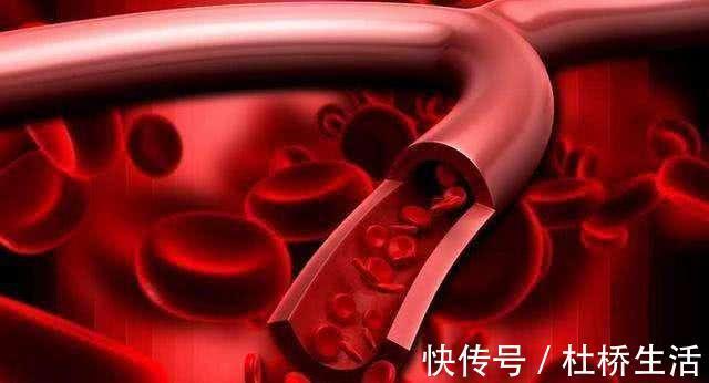血栓|天然的血管“清道夫”食物找到了,多吃血液不粘稠,血栓不来扰