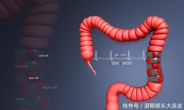 消化科医生提醒这样的大便，可能是大肠癌上身