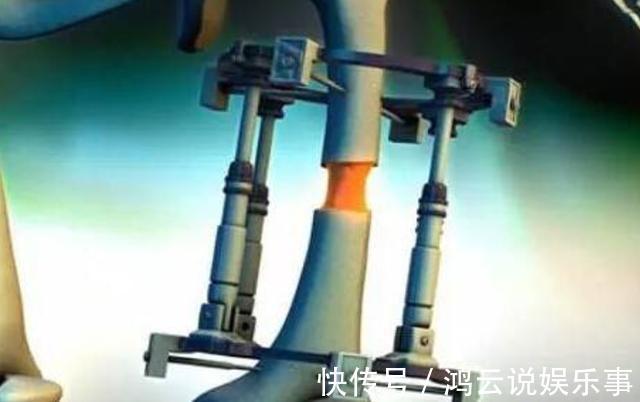 增高|还记得那个花16万、断骨增高7.2厘米的李亚诺吗?后来身体怎样?