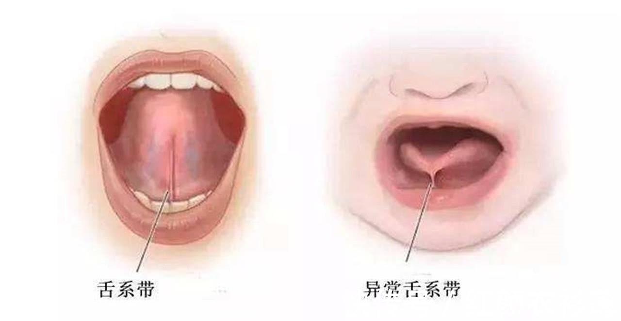科学|为什么有的孩子出生之后,就被把舌根剪掉?看完真是刷新我的认知